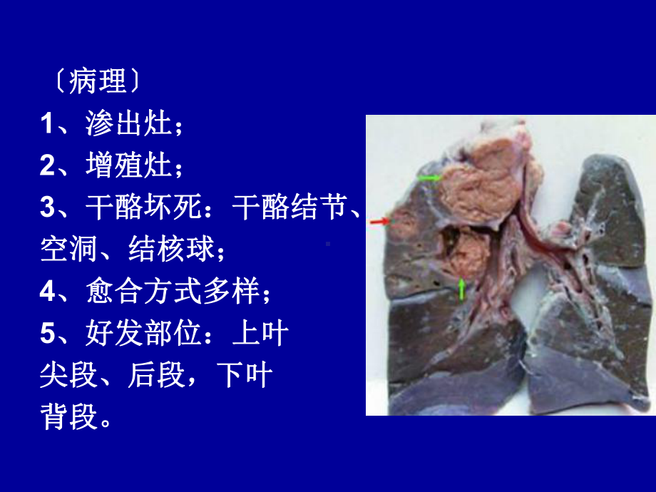 继发性肺结核课件.ppt_第3页