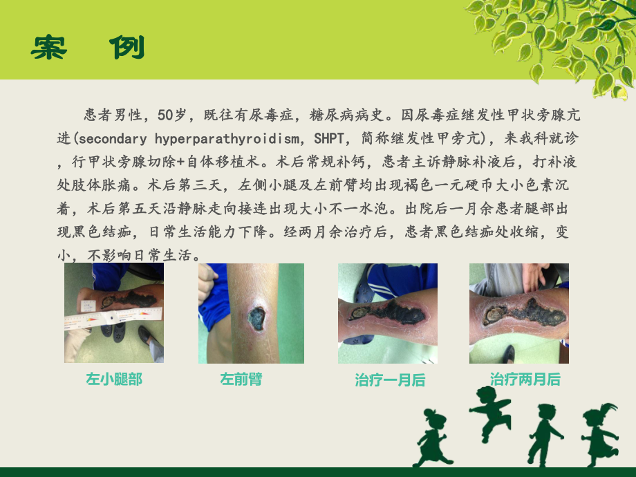 降低高渗性药物输液外渗与静脉炎的持续质量改进pp课件.ppt_第2页