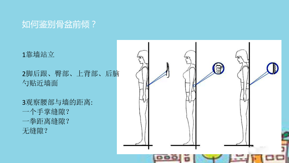 下交叉综合症课件.ppt_第3页