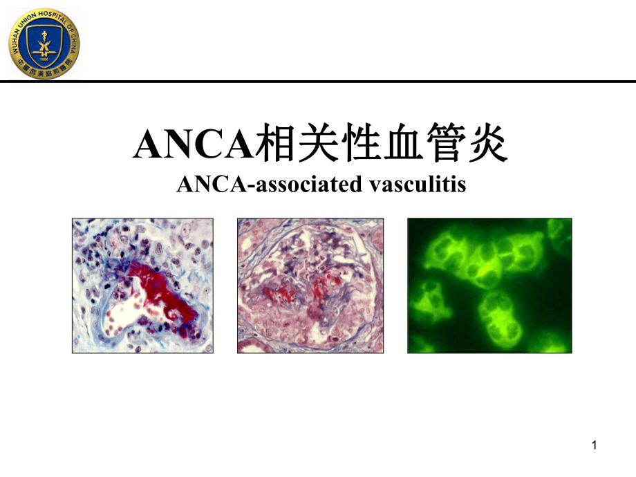 ANCA相关性血管炎PPT课件.ppt_第1页