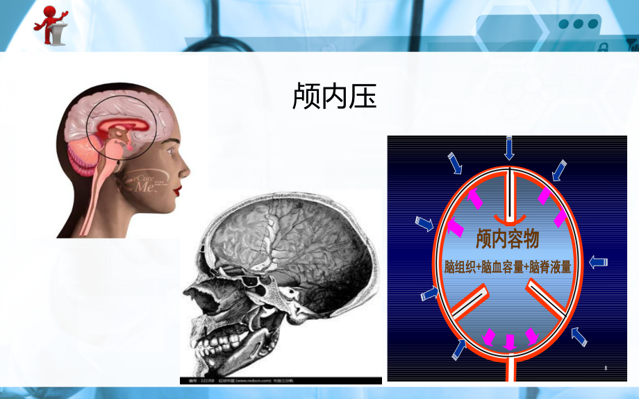 《外科护理》第十章-第一节-颅内压增高病人的护理课件.ppt_第3页