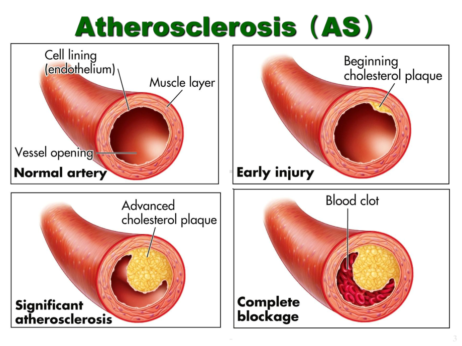 药理学-调血脂药与抗动脉粥样硬化药PPT课课件.ppt_第3页