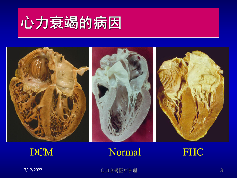 心力衰竭医疗护理课件.ppt_第3页