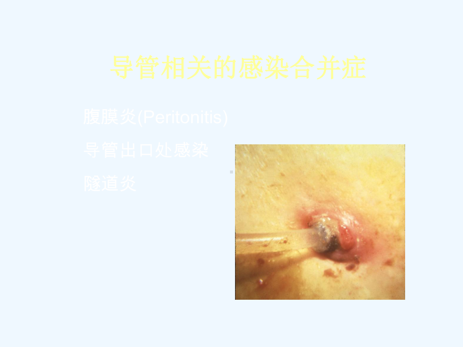 腹膜炎的诊断和治疗课件.ppt_第2页