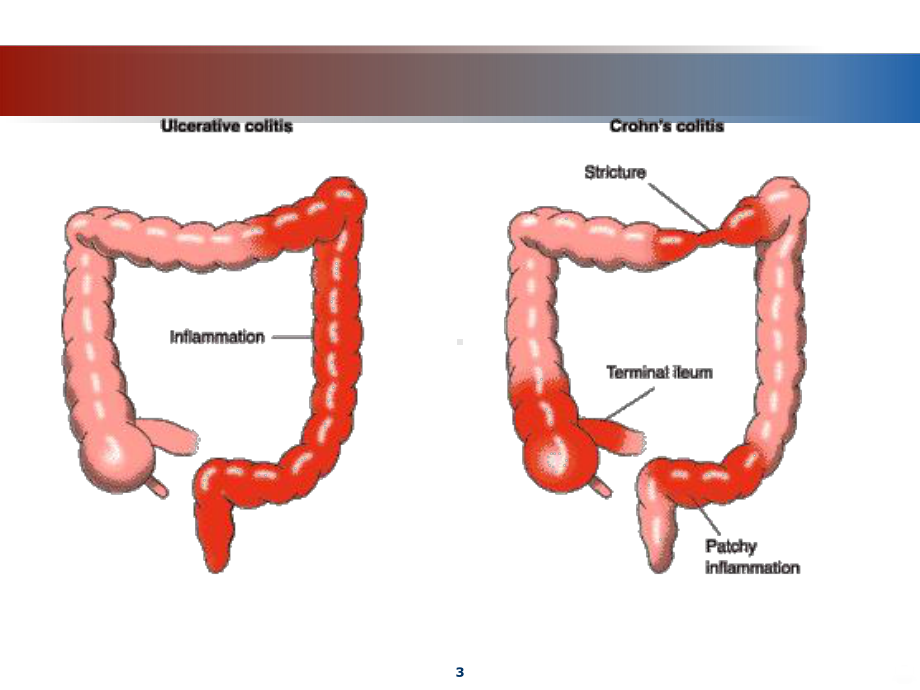 炎症性肠病的药物治疗PPT课件.ppt_第3页