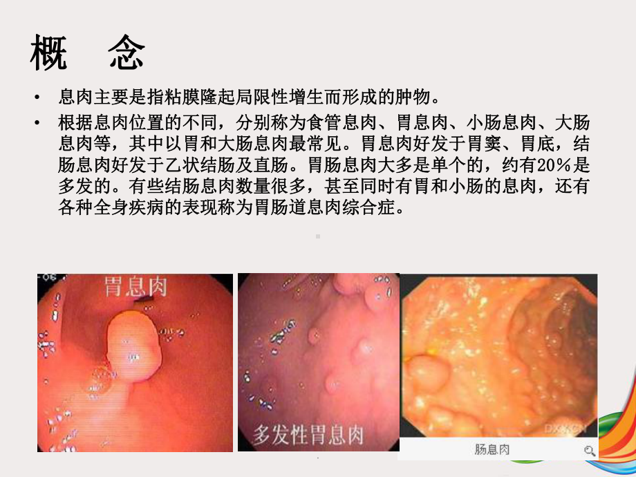 胃、肠息肉摘除术PPT演示课件.ppt_第2页