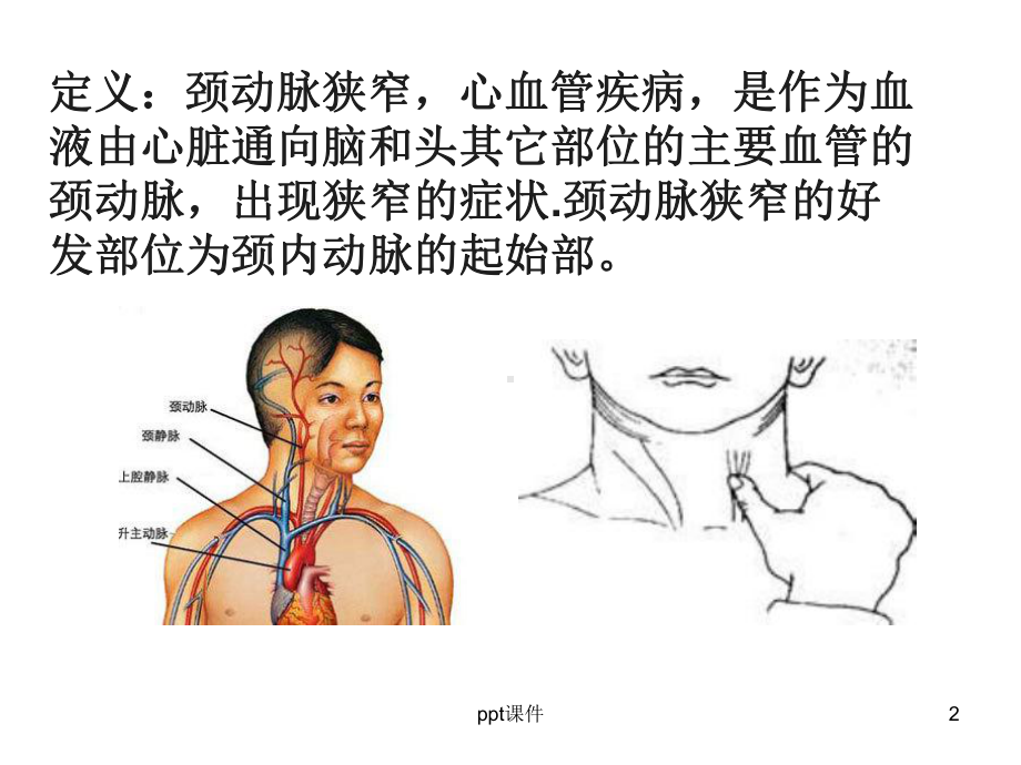 颈动脉狭窄-ppt课件.ppt_第2页