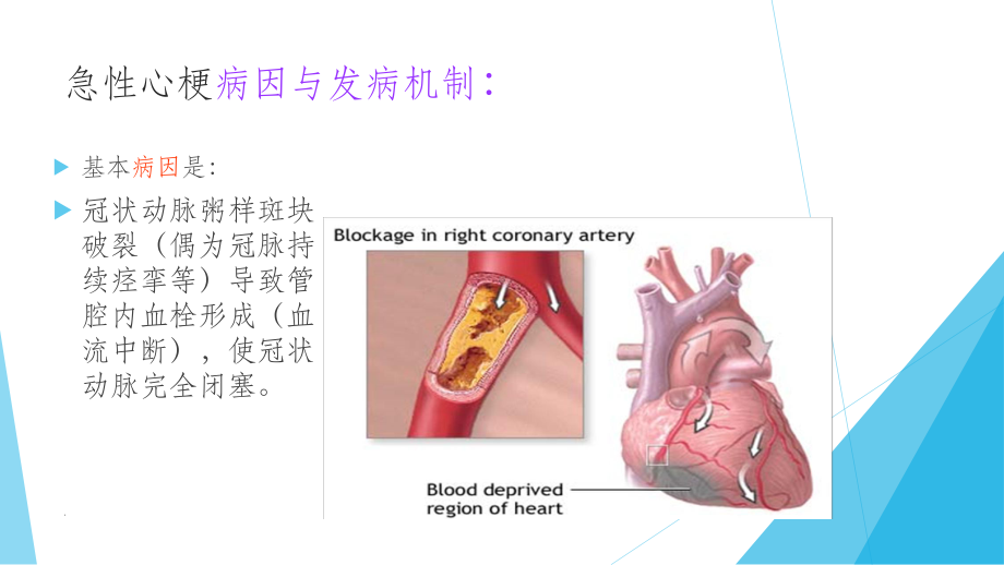 急性心梗溶栓的护理ppt课件.ppt_第3页