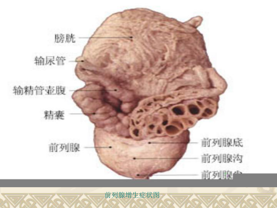 前列腺电切术护理课件.ppt_第3页