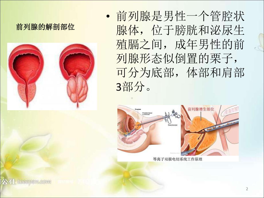 前列腺电切术(TURP)PPT课件.ppt_第2页