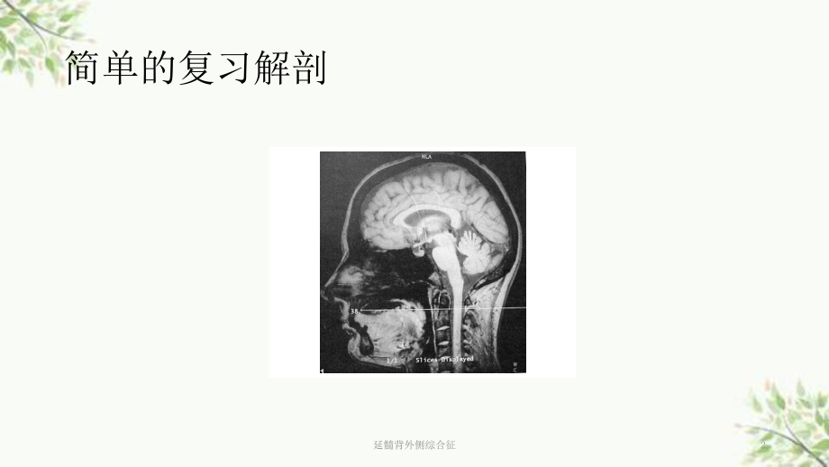 延髓背外侧综合征课件.ppt_第2页