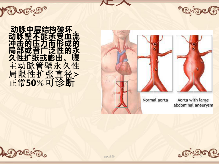 腹主动脉瘤（普外科）-ppt课件.ppt_第3页