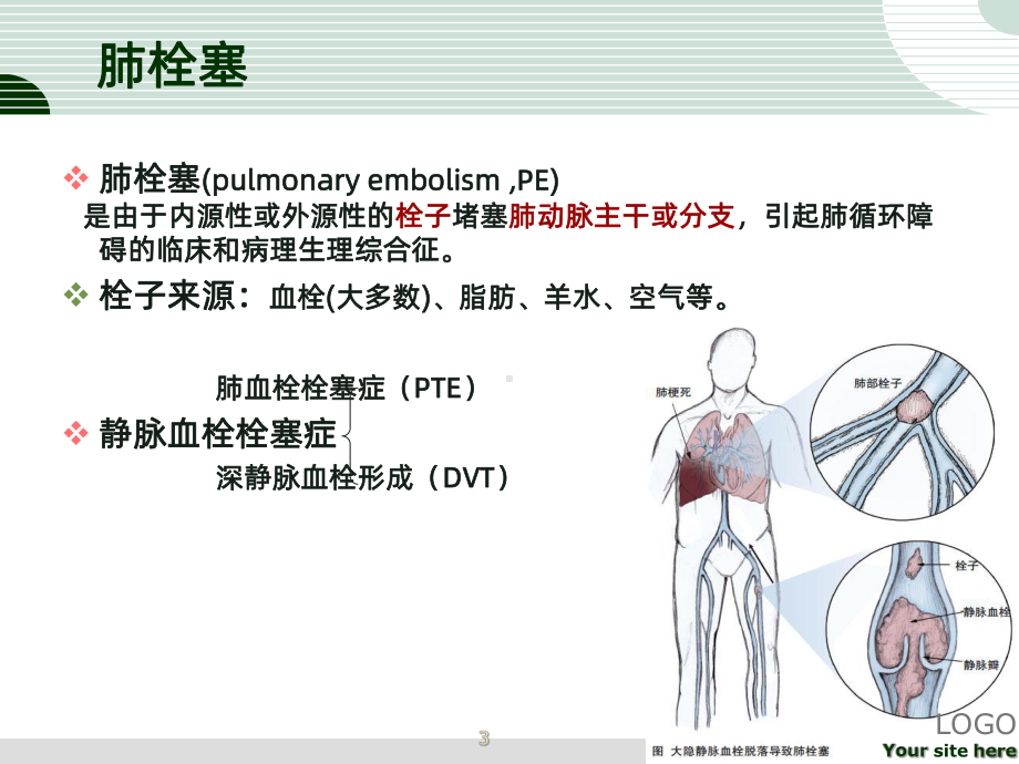 肺栓塞溶栓的护理PPT课件.ppt_第3页