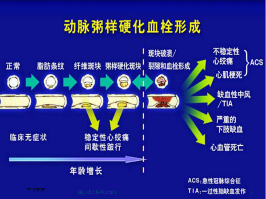 颈动脉斑块科普知识培训课件.ppt_第3页