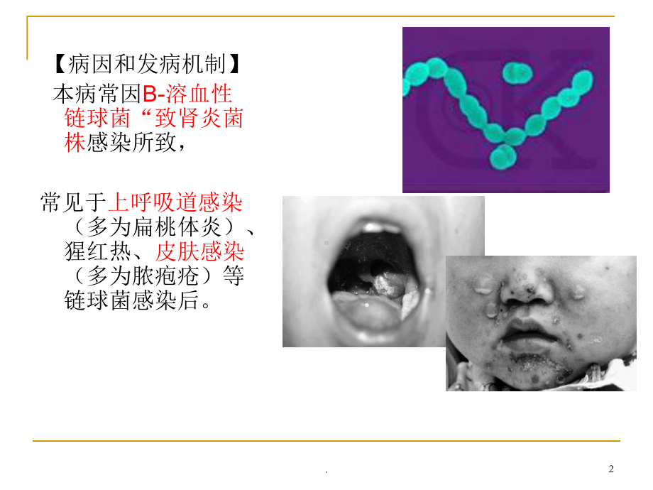 急性肾小球肾炎PPT课件1.ppt_第2页