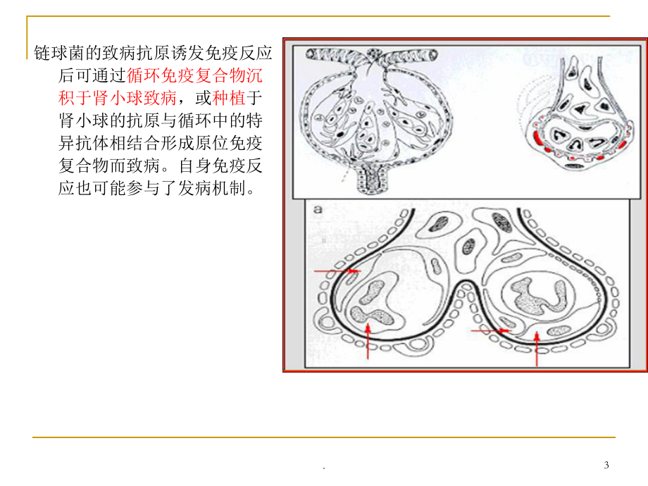 急性肾小球肾炎PPT课件1.ppt_第3页