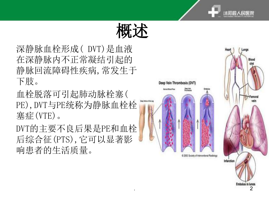 深静脉血栓形成的诊断与治疗指南PPT课件.ppt_第2页