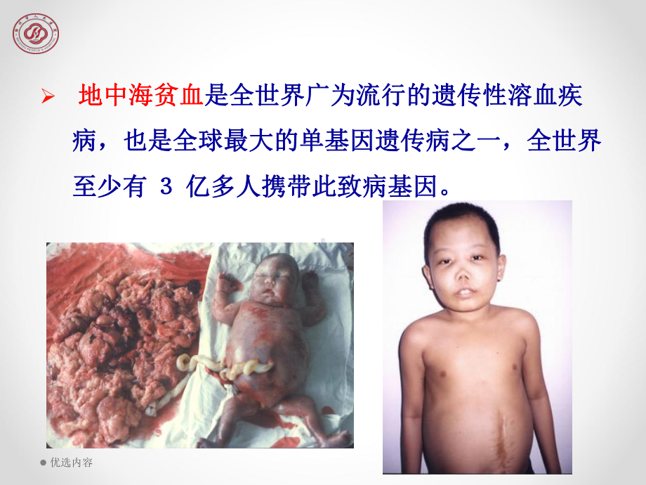 地中海贫血的现状与讨论(特选参考)课件.ppt_第3页