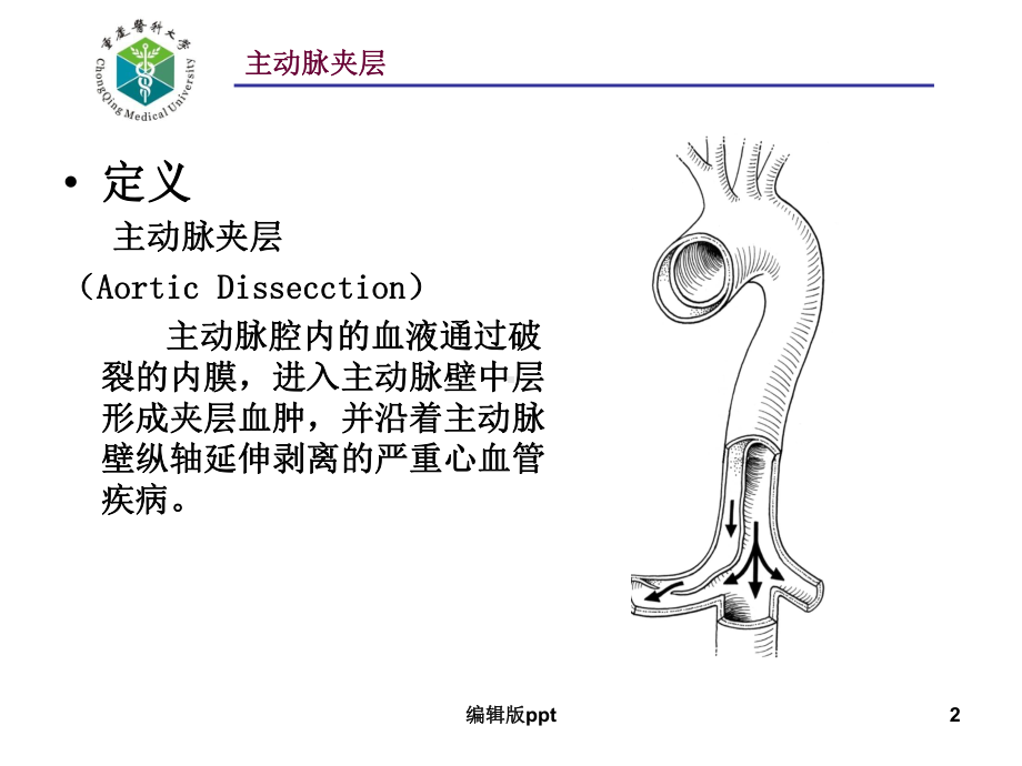 主动脉夹层的诊治课件.ppt_第2页