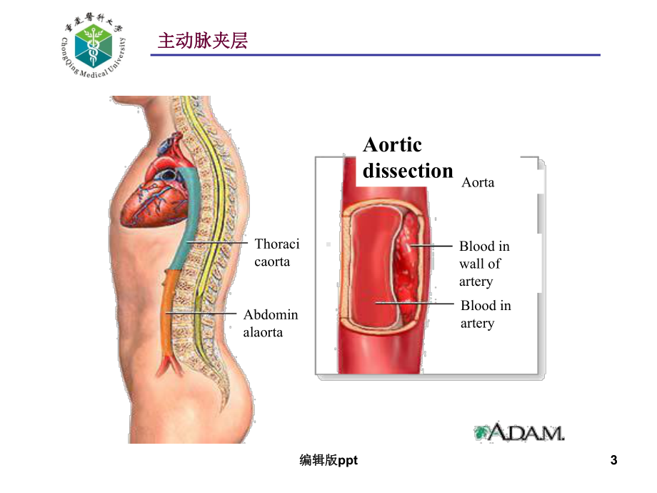 主动脉夹层的诊治课件.ppt_第3页