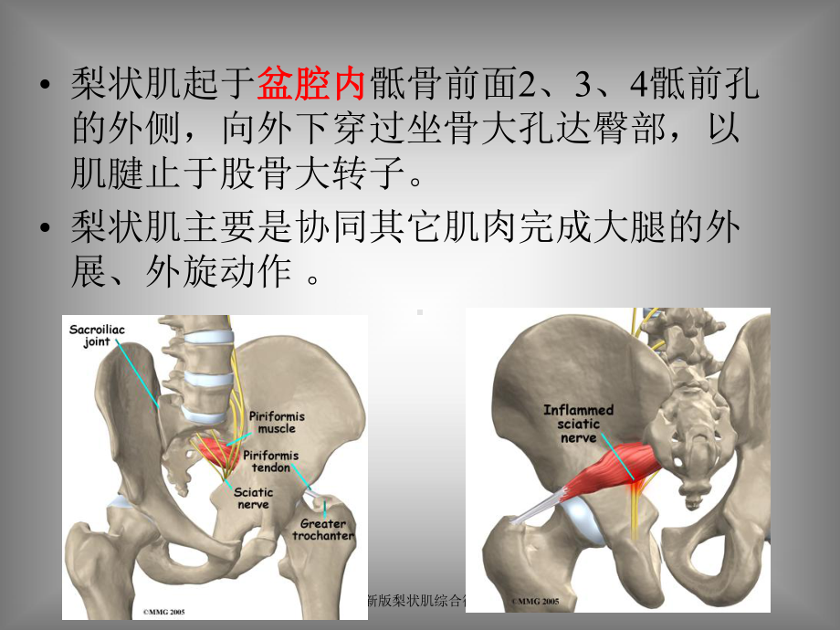 新版梨状肌综合征培训课件.ppt_第3页