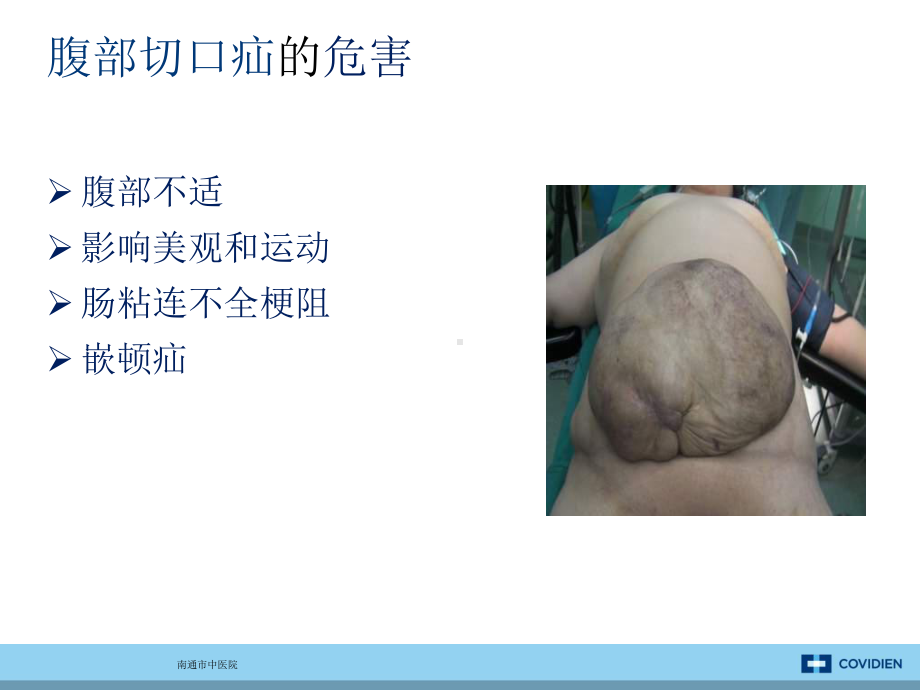 最新腹壁疝的治疗主题讲座课件.ppt_第2页