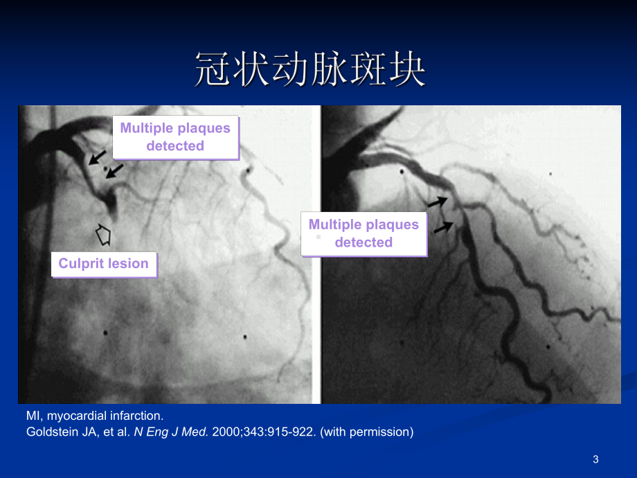 心肌缺血PPT课件.ppt_第3页