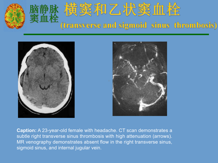 横窦和乙状窦血栓PPT课件.ppt_第3页