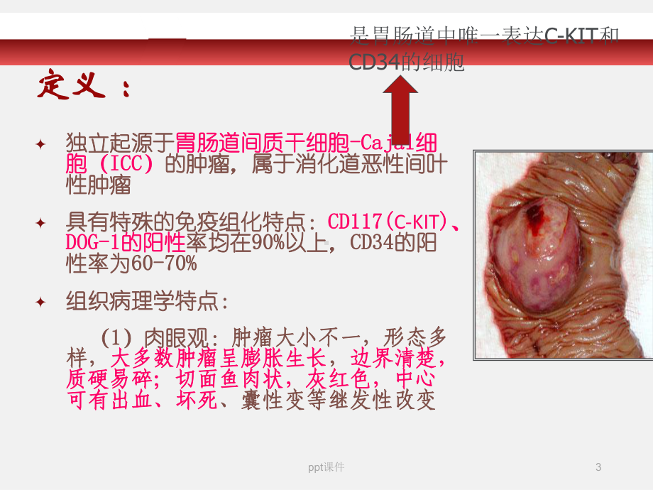 胃肠间质瘤-ppt课件.ppt_第3页