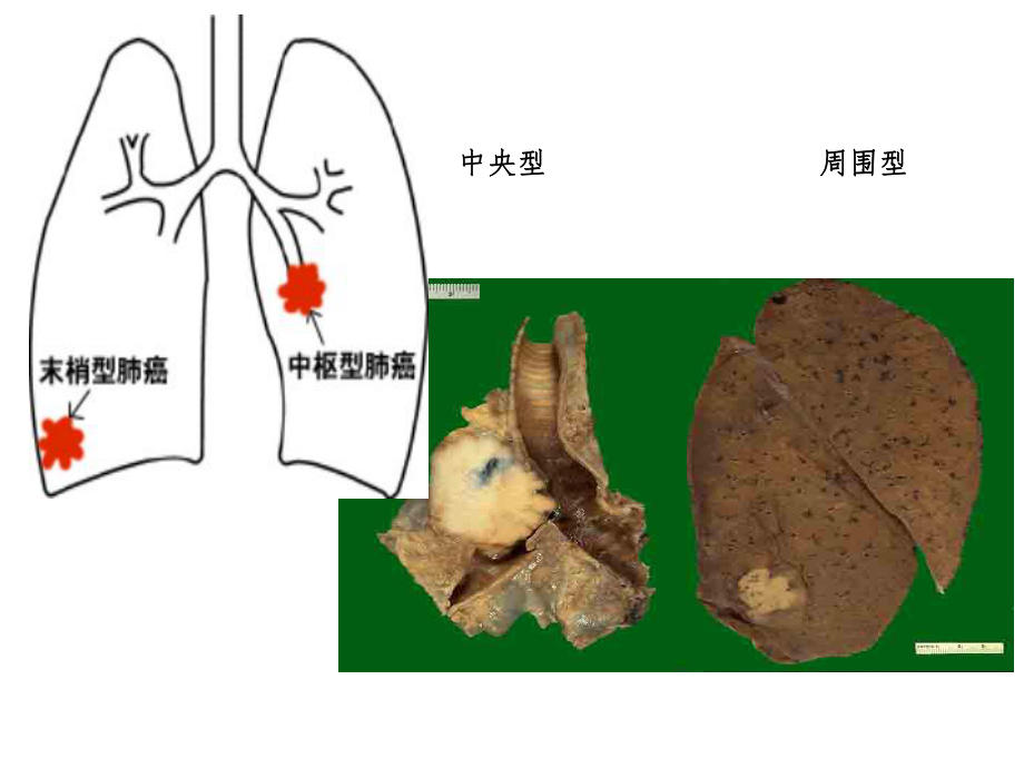 肺癌影像诊断课件.pptx_第3页