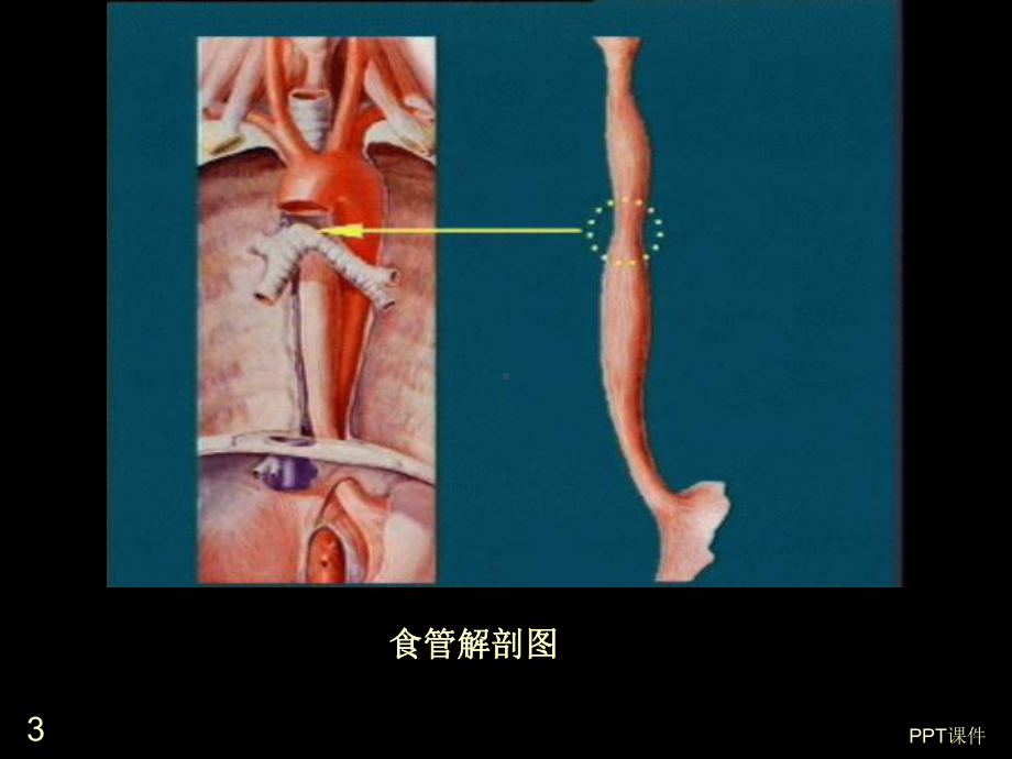 胃食管反流病-ppt课件.ppt_第3页