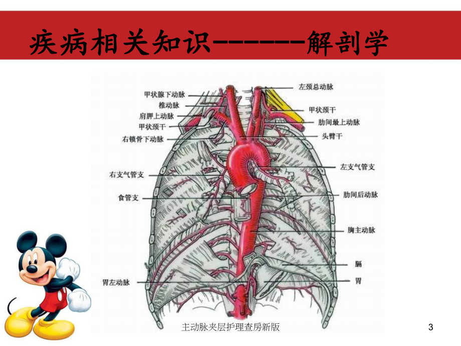 主动脉夹层护理查房新版培训课件.ppt_第3页