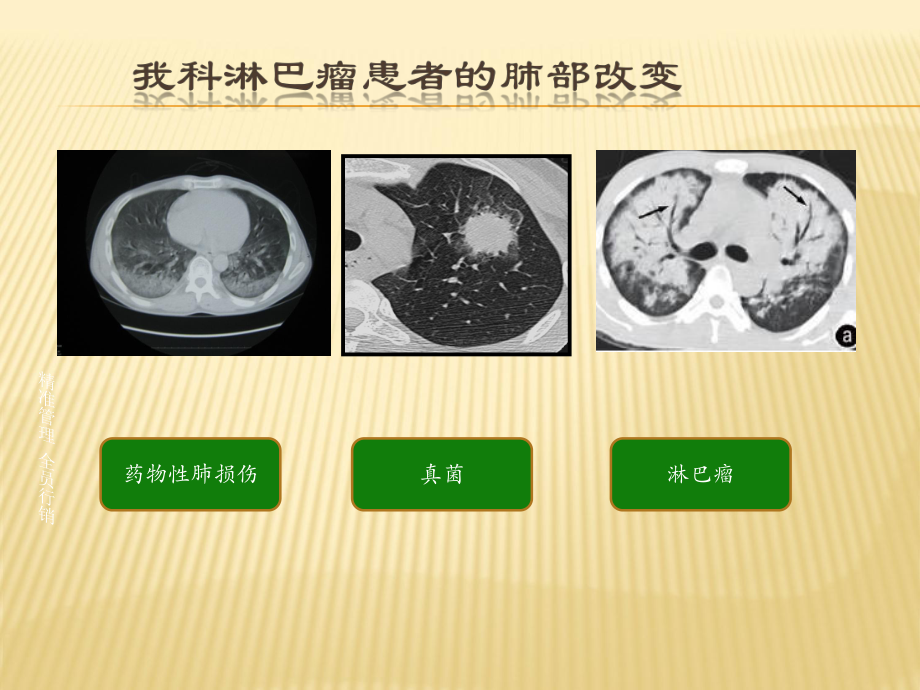 药物性肺损伤课件.ppt_第3页