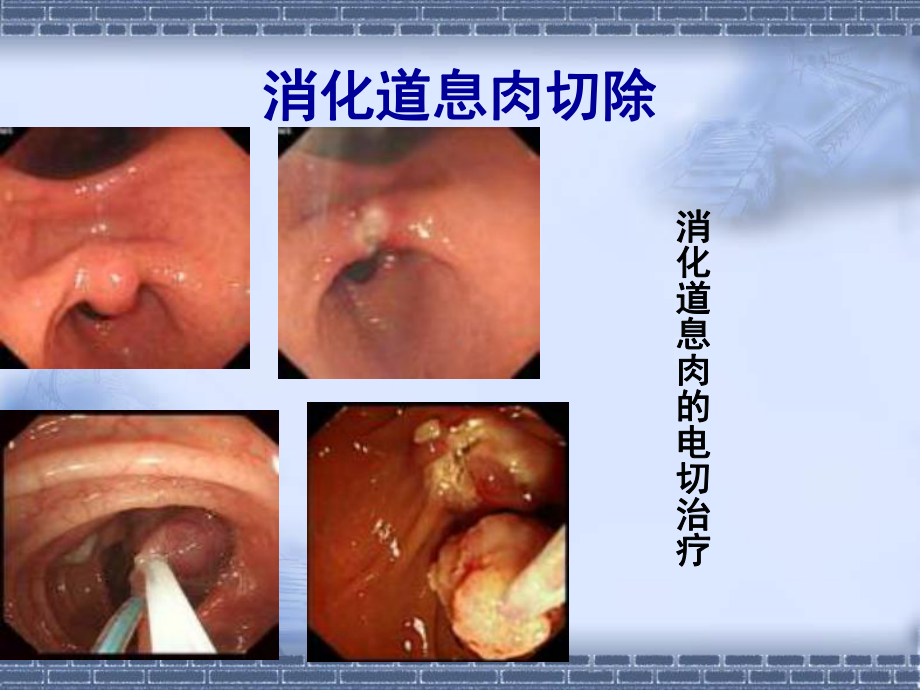 消化道占位的内镜下治疗PPT培训课件.ppt_第2页