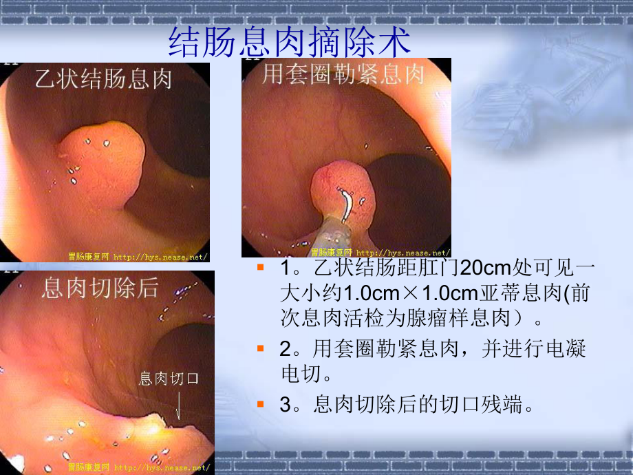 消化道占位的内镜下治疗PPT培训课件.ppt_第3页