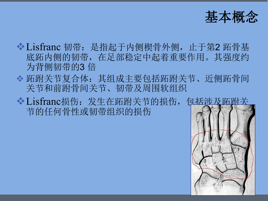 Lisfranc-跖跗关节损伤-PPT课件.ppt_第3页