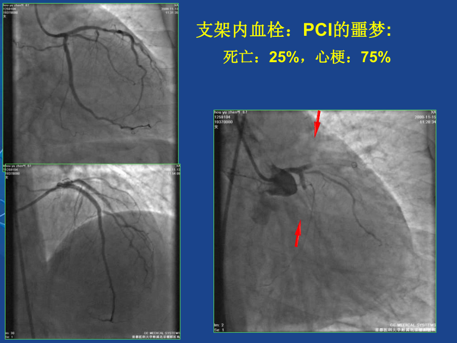 ACS患者PCI围术期出血并发症-PPT课件.ppt_第3页