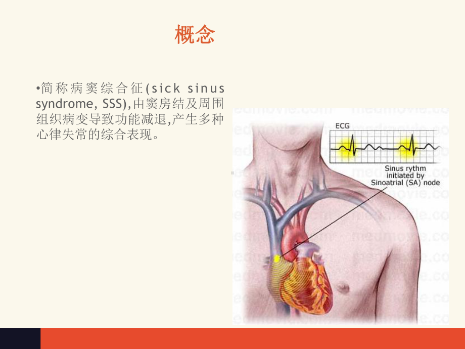 病态窦房结综合征-ppt课件.ppt_第2页