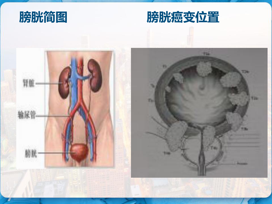 膀胱癌术后病员的术后护理-PPT课件.pptx_第3页