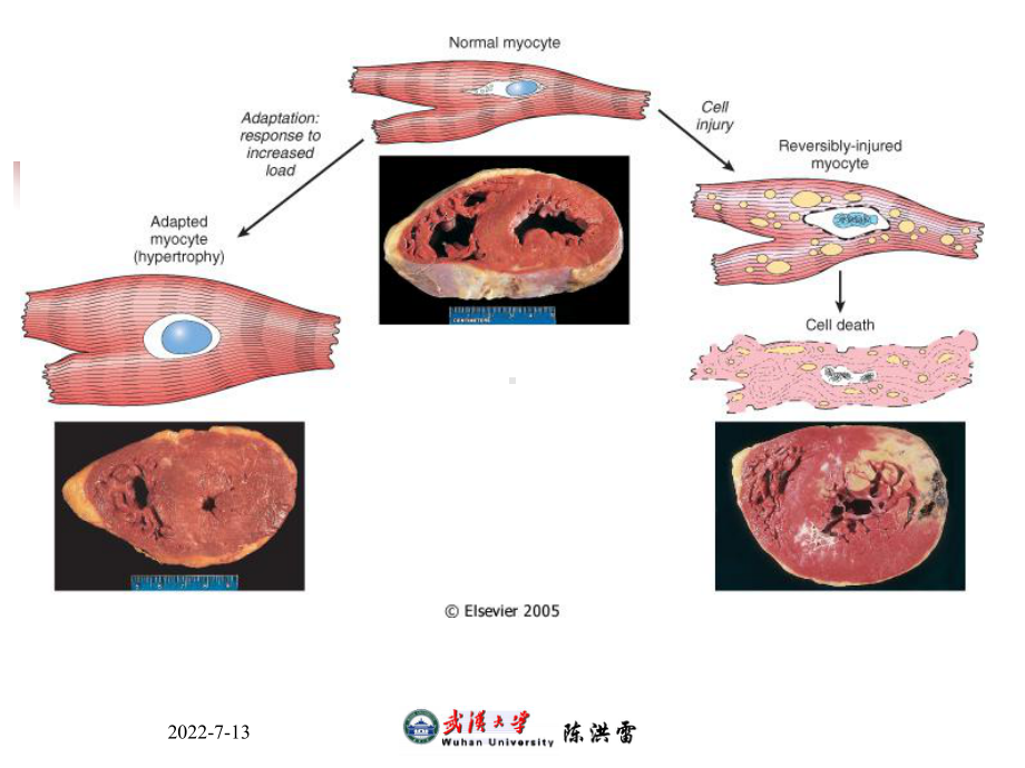 病理学适应和损伤课件.ppt_第3页