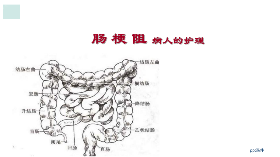 外科护理学-肠梗阻病人的护理-ppt课件.pptx_第1页