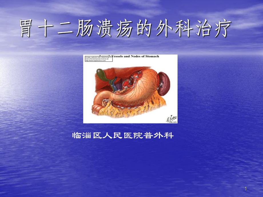 胃十二肠溃疡的外科治疗PPT课件.ppt_第1页