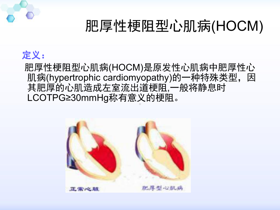 肥厚梗阻型心肌病PPT医学课件.pptx_第3页