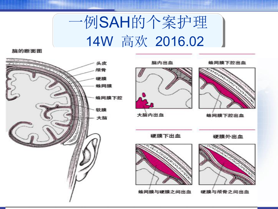 蛛网膜下腔出血的个案护理分析-PPT课件.ppt_第2页