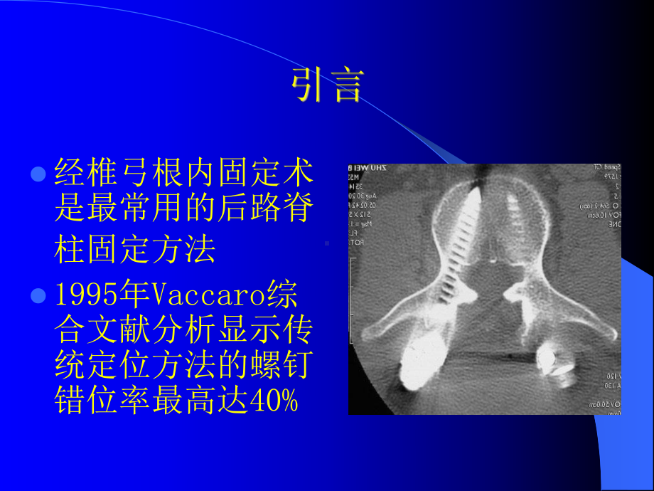 经椎弓根胸腰椎内固定进针方法研究进展课件.ppt_第2页