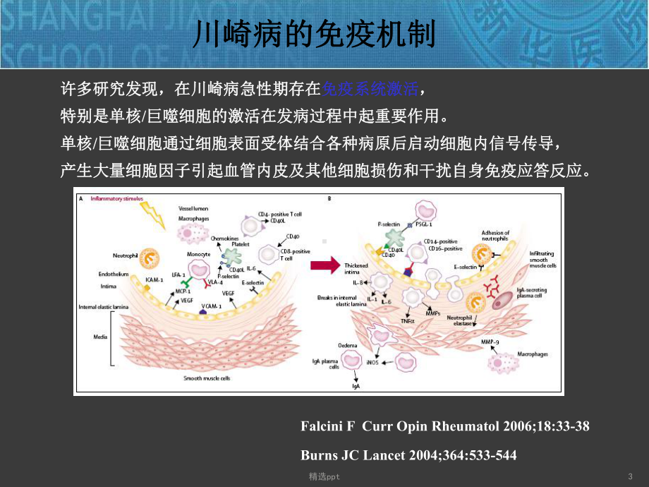 川崎病心血管课件.ppt_第3页