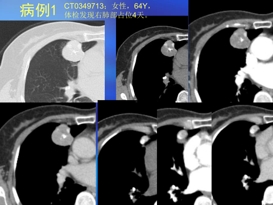 肺部错构瘤CT鉴别诊断病例随访课件.ppt_第1页