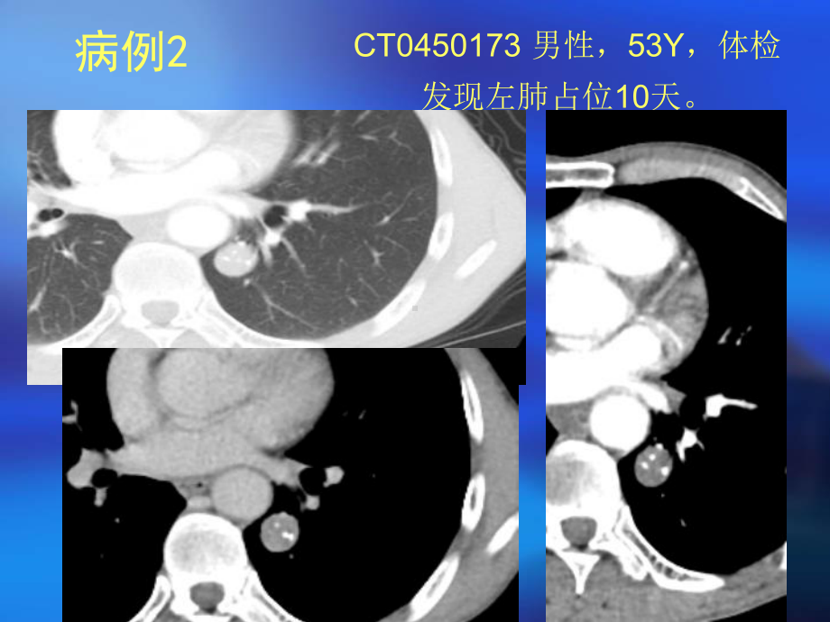 肺部错构瘤CT鉴别诊断病例随访课件.ppt_第3页