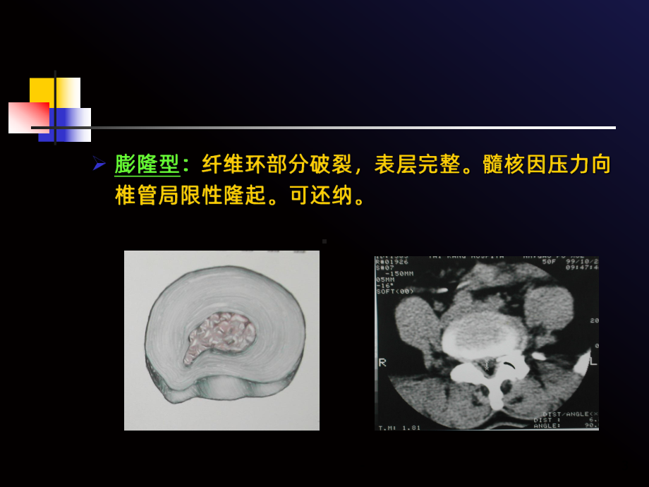 腰椎间盘突出症病人的护理ppt课件.ppt_第3页