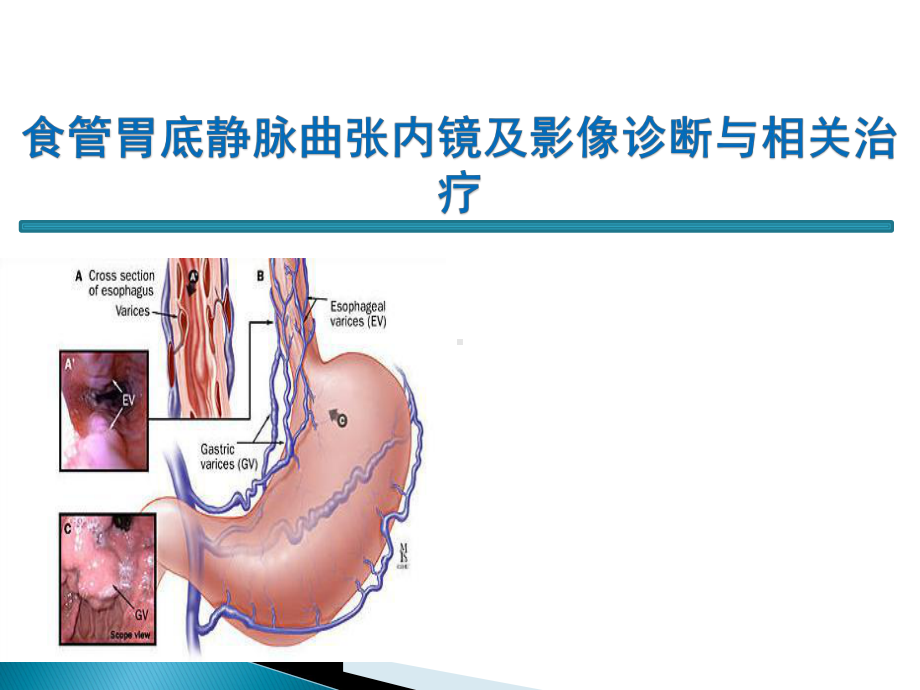 食管胃底静脉曲张内镜及影像诊断与相关治疗课件.ppt_第1页